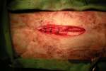 Simple interrupted sutures